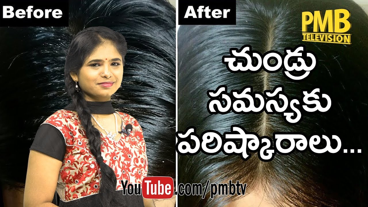 Dandruff and Hair fall Home Remedies  The home remedies for dandruff are  easy to understand You can learn how to control or get rid of dandruff  with these simple home remedies